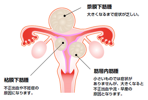 子宮筋腫の説明図です