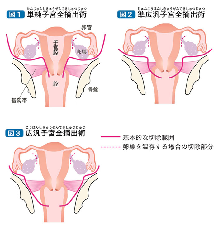 子宮頸がんの説明図です。