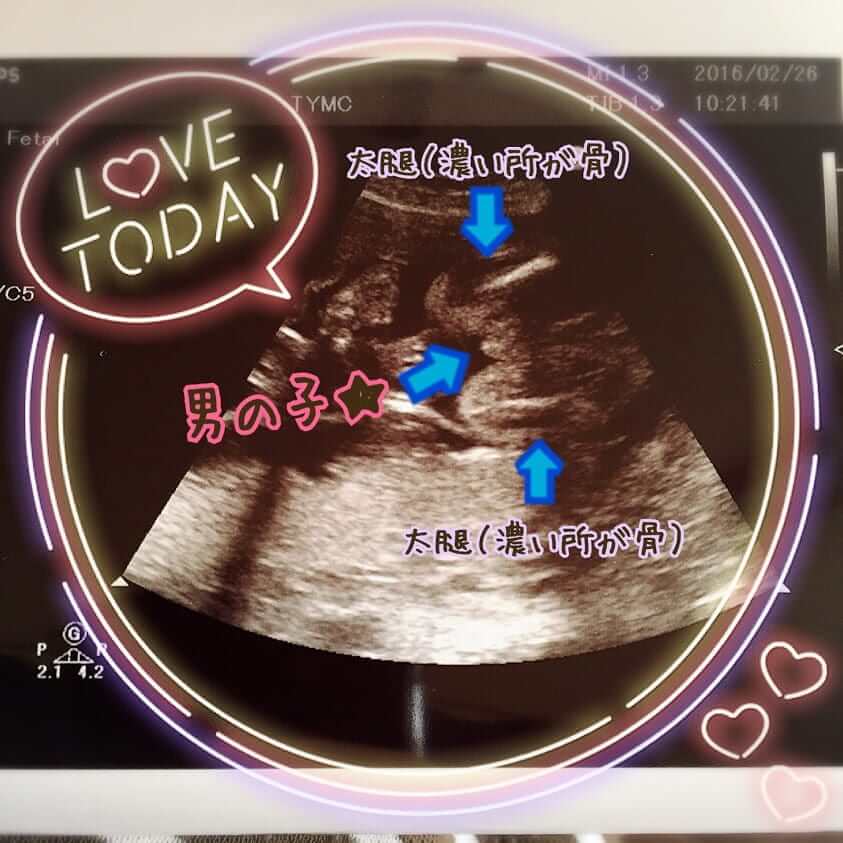 妊娠24wの胎児のエコー写真です。