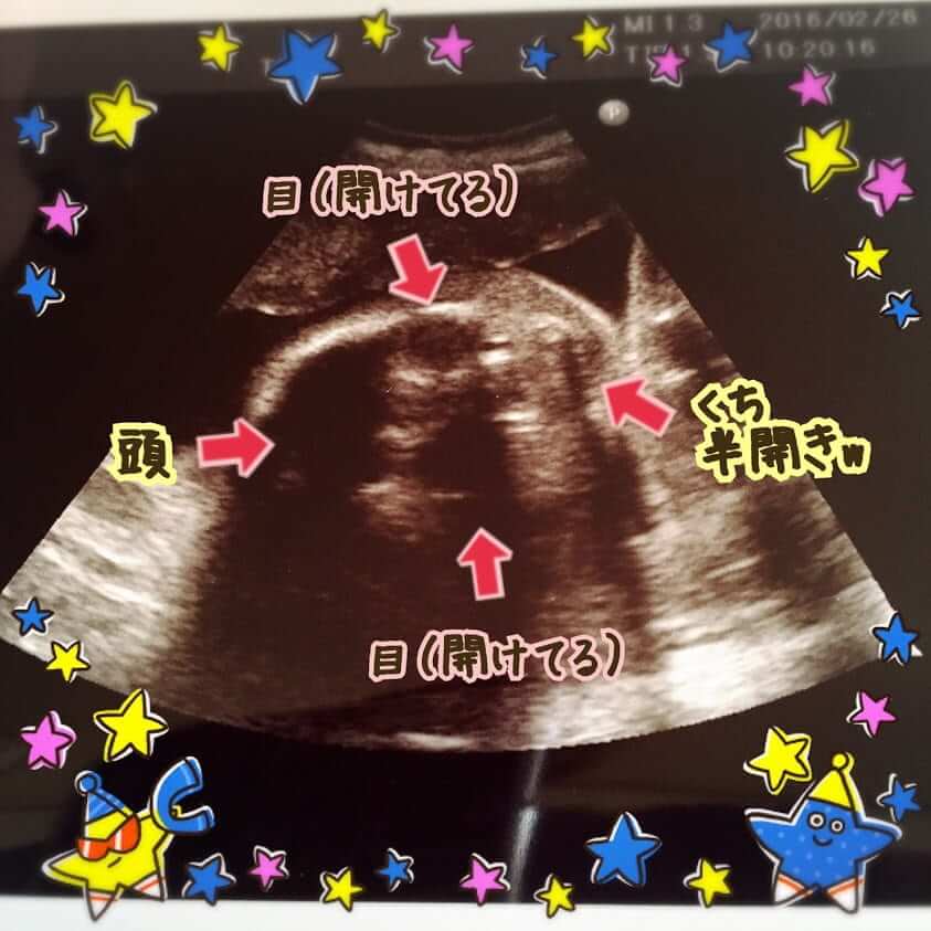 妊娠24wの胎児のエコー写真です。