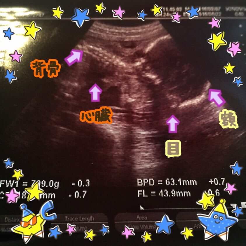 妊娠25wの胎児のエコー写真です。
