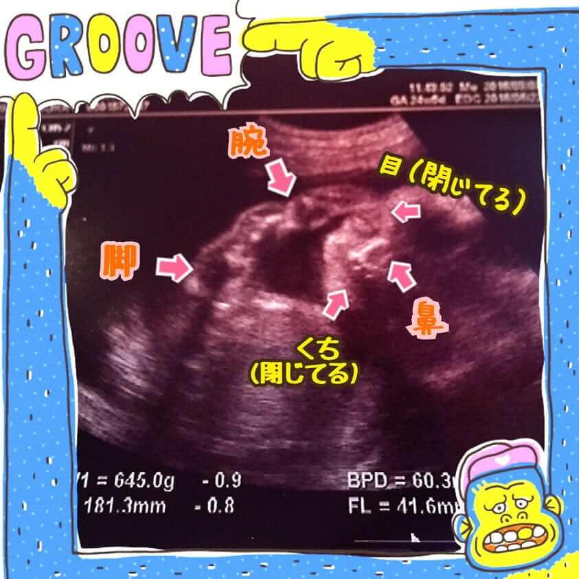 妊娠25wの胎児のエコー写真です。