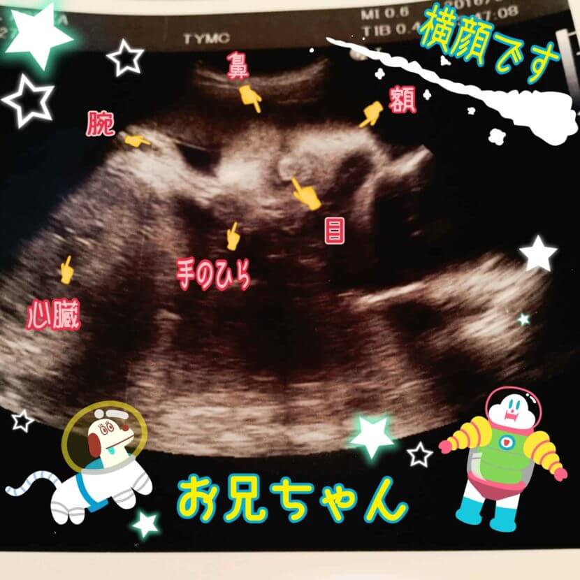 妊娠29wの胎児のエコー写真です。