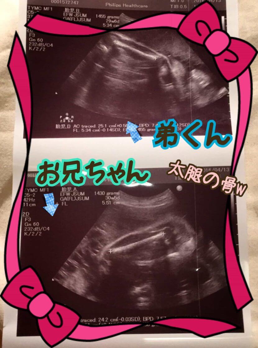 妊娠30wの胎児のエコー写真です。