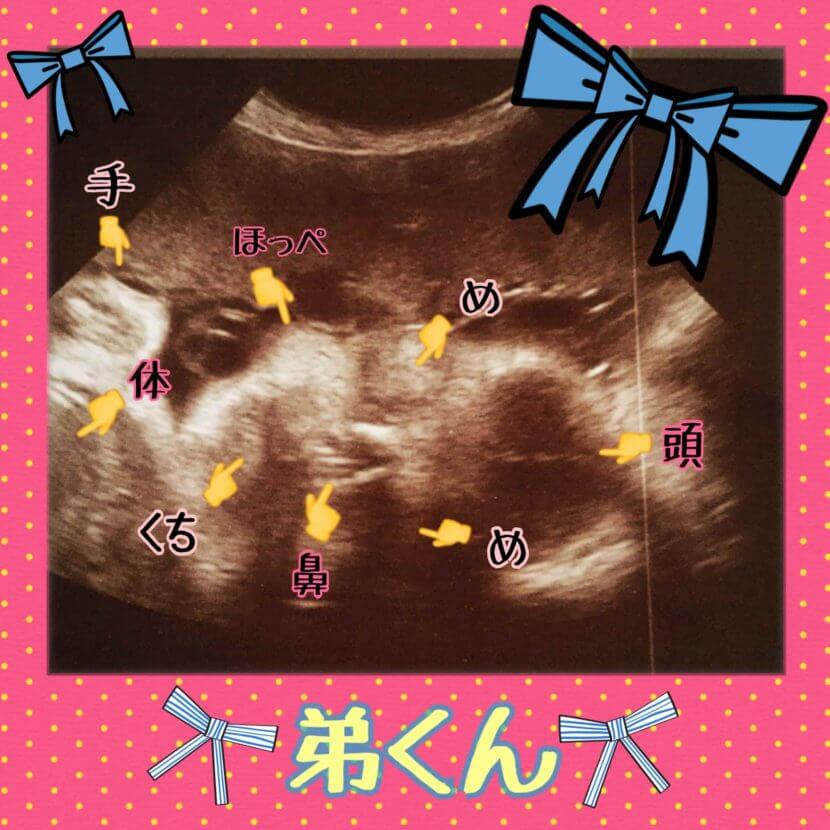 妊娠31wの胎児のエコー写真です。