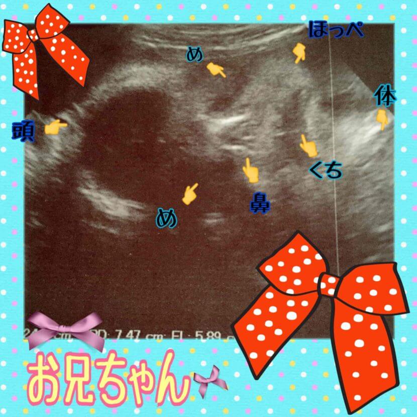 妊娠31wの胎児のエコー写真です。