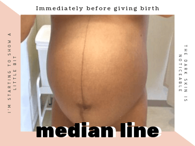 妊娠中お腹の真ん中に縦線 正中線は消えるの 産前 産後お腹の画像比較 双子男子